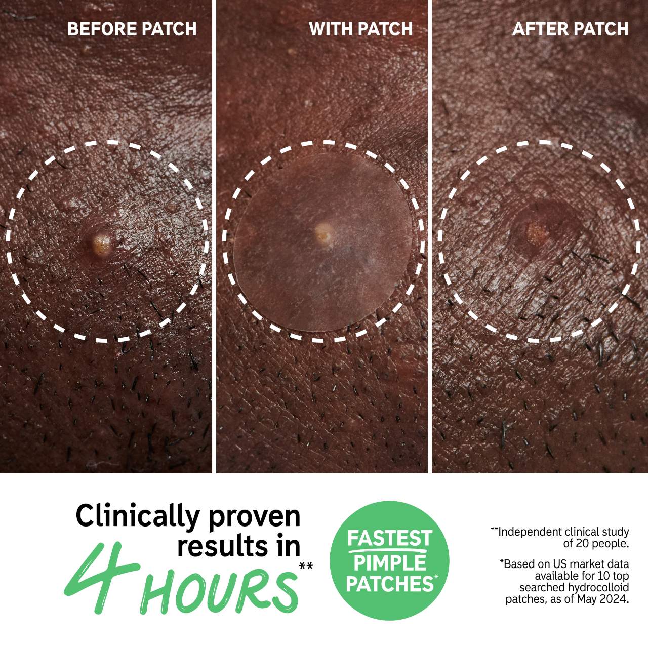 The Inkey List - Hydrocolloid Invisible Pimple Patches