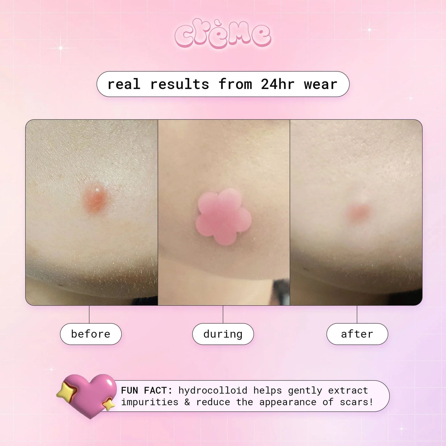 The creme shop - Petal Perfect Skin Hydrocolloid Acne Patches Pink & Holographic